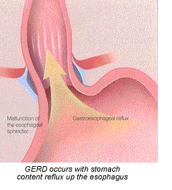 Gastro-Esophageal Reflux Disease Regimen